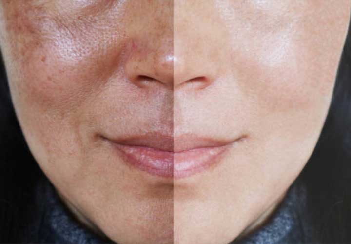 What is melasma & how to manage it?